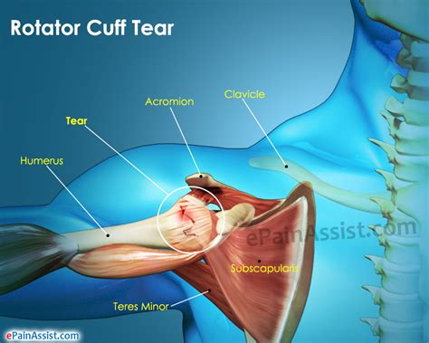 Rotator Cuff Tear Diagram