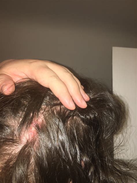 Help Needed Rpopping I Have An Angry Lump On The Back Of My Head No