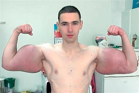 This Russian Bodybuilder With Inch Biceps Could Lose His Arms