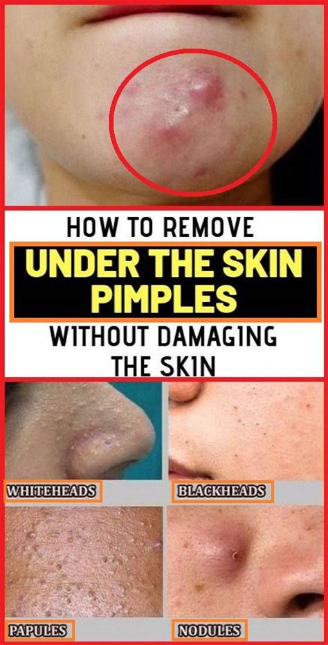 Remove Under The Skin Pimples Without Damaging Your Skin In 2020 With