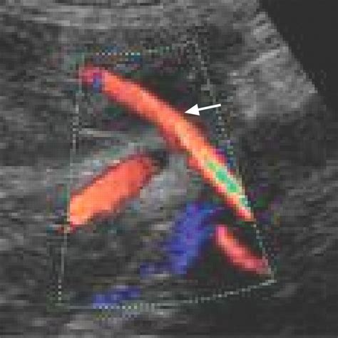How Useful Is Uterine Artery Doppler Ultrasonography In Predicting Pre