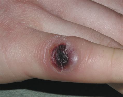 Ulcer Skin Lesion