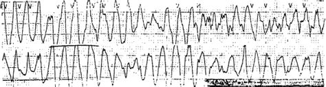 Qtc Prolongation And Torsades De Pointes Associated With Methadone