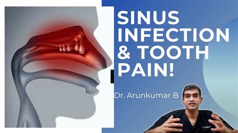 Sinusitis Can Sinus Infection Cause Tooth Ache Dr Arunkumar Pearls Dentistry Chennai Dental