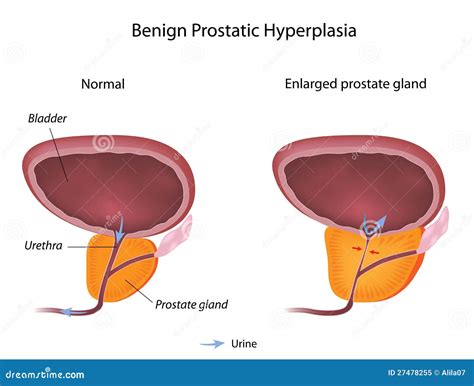 Hiperplazia De Prostata Cauze Simptome Tratament Sfaturimedicale Ro