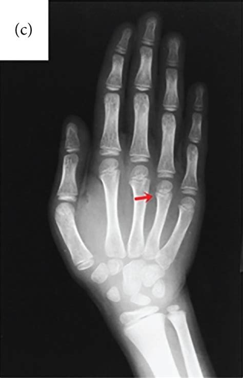 A Frontal Bossing B Malocclusion C Shortened Fourth Metacarpal