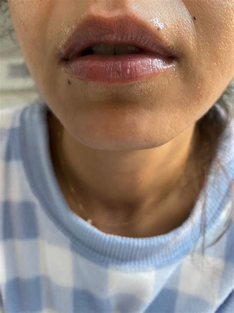 White Bump On Lip What Is This Noticed Few Days Ago Off Accutane For