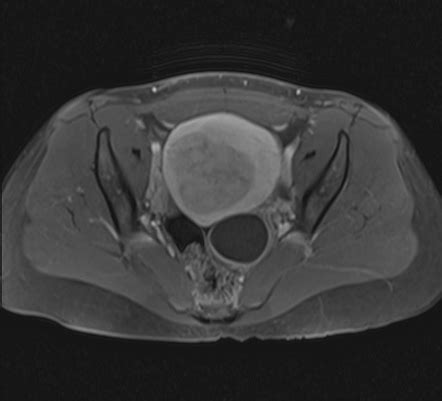 Ovarian Follicular Cyst Radiology Reference Article Radiopaedia Org