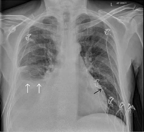 Use Of Chest X‐ray For Early Differentiation Between Constrictive And