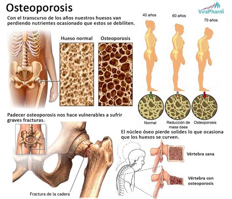 Osteoporosis Infografía La Osteoporosis Es Una Enfermeda Flickr