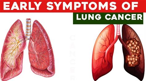 5 Early Warning Signs Of Lung Cancer You Shouldnt Ignore Youtube