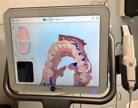 3d Itero Scanner Kenneth E Myers Dds General And Restorative