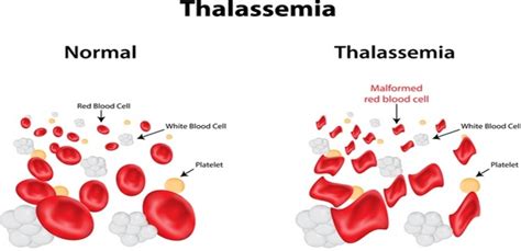 Thalassemia is an inherited blood disorder that is passed down through the parent's genes. What is thalassemia? - Quora