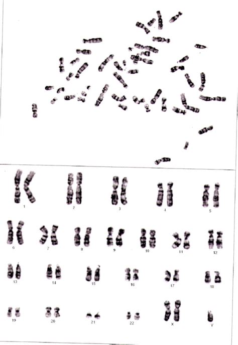 Figure From Karyotype Revealed Xxy Chromosome Klinefelter