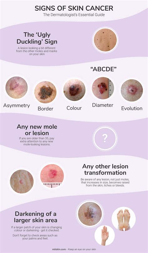 Early Signs Of Skin Cancer Moles Exurt