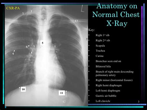 In fact every radiologst should be an expert in chest film reading. Chest X-ray anatomy