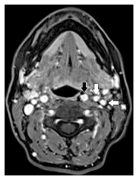 Patient 2 T1 Weighted Enhanced Mri Scan Ovoid Mass Occupying The Left