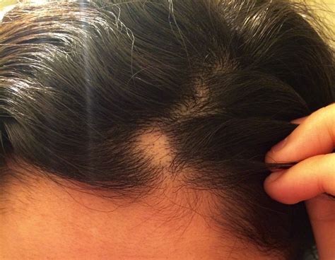 25 F Bald Spot On Scalp It Just Happened One Morning And Is Slowly