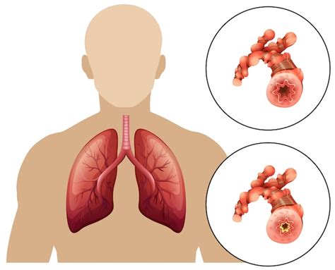 Enfermedad pulmonar obstructiva crónica humana Vector Premium