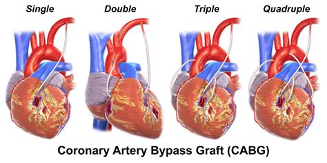 Coronary Artery Bypass Grafting Cabg Almostadoctor