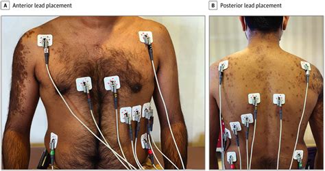 Influence Of Prone Positioning On Electrocardiogram In A