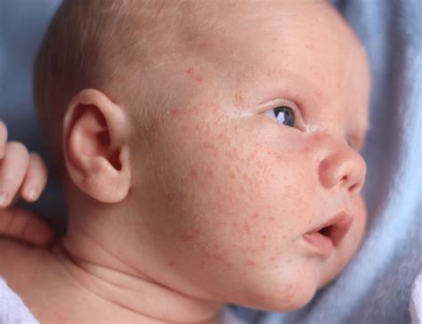 The Difference Between Baby Eczema And Acne