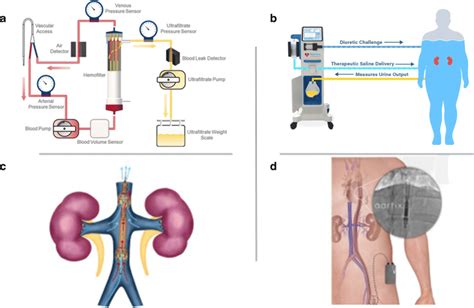Examples Of Devices To Treat Fluid Overload In Heart Failure And The Download Scientific