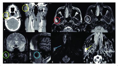 Pleomorphic Adenoma Axial A And Coronal B Ct Scan With Contrast