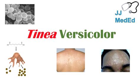 “fungal Skin Infection Of Many Colors” Tinea Versicolor