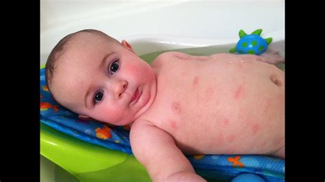 Eczema And Atopic Dermatitis Rashes Causes Symptoms