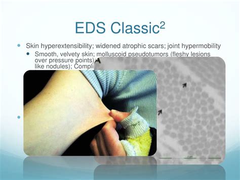 Ppt Ehlers Danlos Syndrome Eds Powerpoint Presentation Free