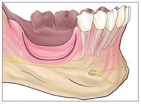 12 Smile Osteotomy Pocket Dentistry