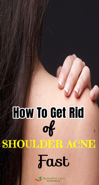How To Get Rid Of Shoulder Acne Fast Remedies Lore