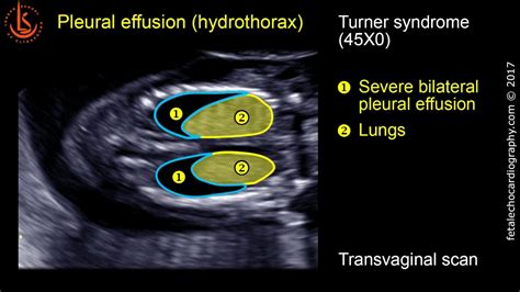 Pleural Effusion Hydrothorax Obstetric Ultrasound Pleural Effusion My