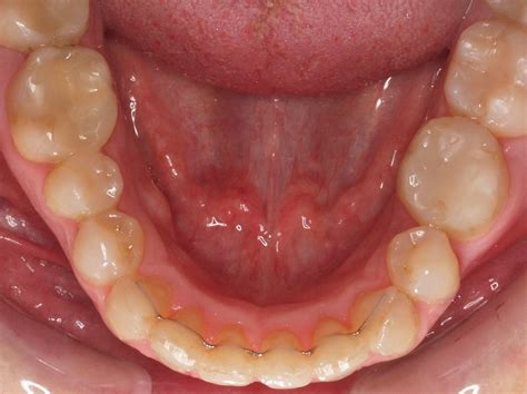 Ortodoncia Lingual Segunda Opinión Tratamiento Ortodoncis