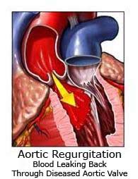 Check spelling or type a new query. Aortic Regurgitation - York Cardiology