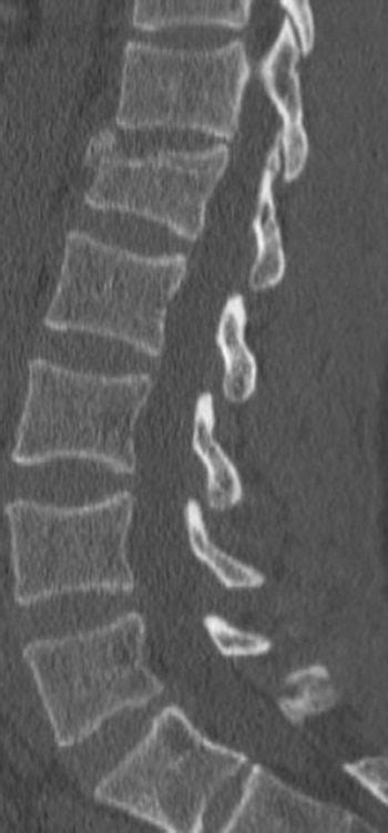 Spine Fracture Undergraduate Diagnostic Imaging Fundamentals