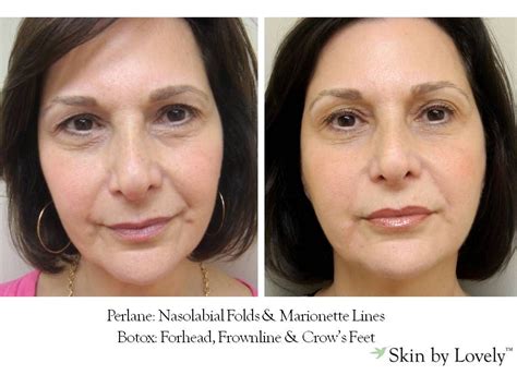 Nasolabial Folds And Marionette Lines Botox Forehead Frownline Crows