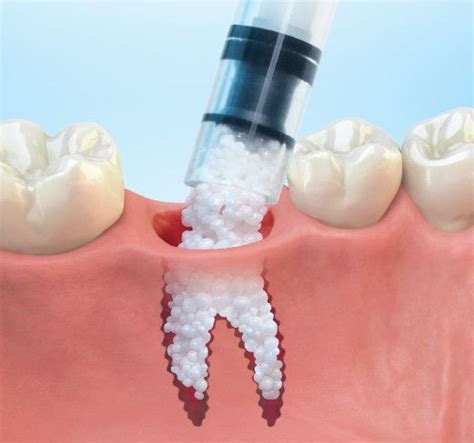 Dsi Alyoss Dental Implant Natural Allograft Human Bone Graft Sterile