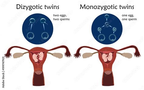 vecteur stock multiple pregnancy dizygotic and monozygotic twins embryo fetus in uterus