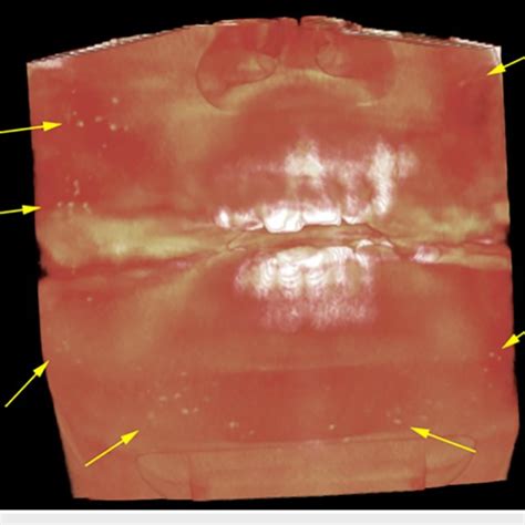 Tonsillar Stones In The Palatine Tonsils A Volumetric Rendering