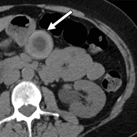 Diagnostic Approach To Benign And Malignant Calcifications In The