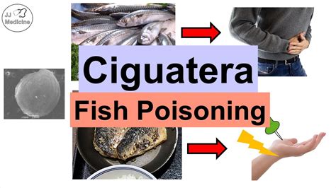 Ciguatera Fish Poisoning Ciguatoxin Symptoms Numb Feet Diarrhea