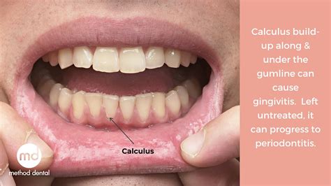 The Difference Between Plaque And Calculus Method Dental