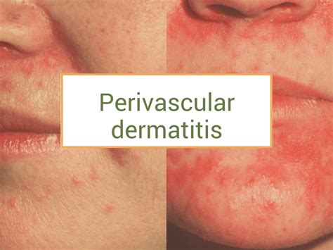 Perivascular Dermatitis Treatments And Natural Recipes With Pictures