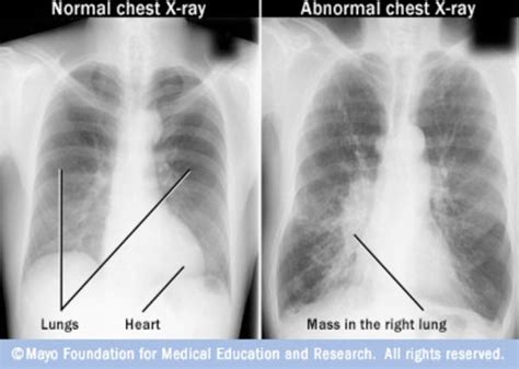 Pa cxr showing rt upper lung cavity with relatively. Early Detection of Lung Cancer Using Nano-Nose - A Review