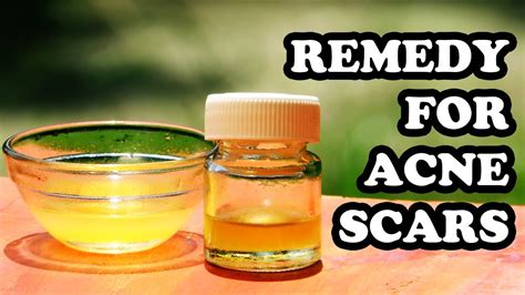Natural Remedies For Acne Scars Best Home Remedies To Get Rid Of Acne Scars At Home Naturally