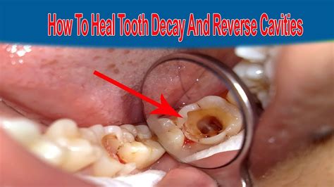 How To Treat Cavitieshealth And Home Remedies Youtube