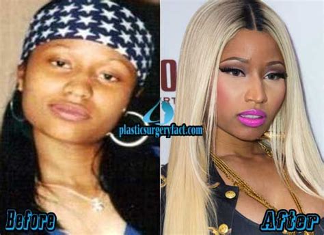 Nicki Minaj Plastic Surgery Before And After