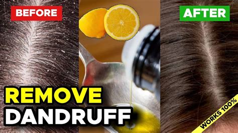 How To Cure Dandruff Permanently Lemon Juice And Coconut Oil Dandruff
